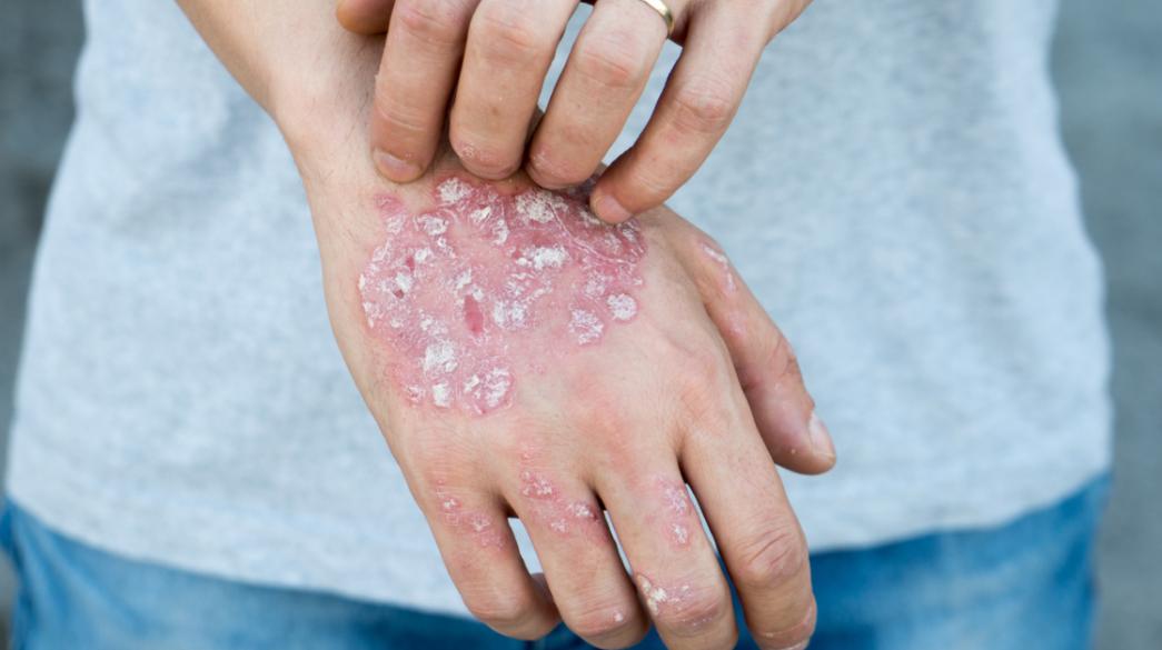 dermatika-psoriasi-stress-ygeia